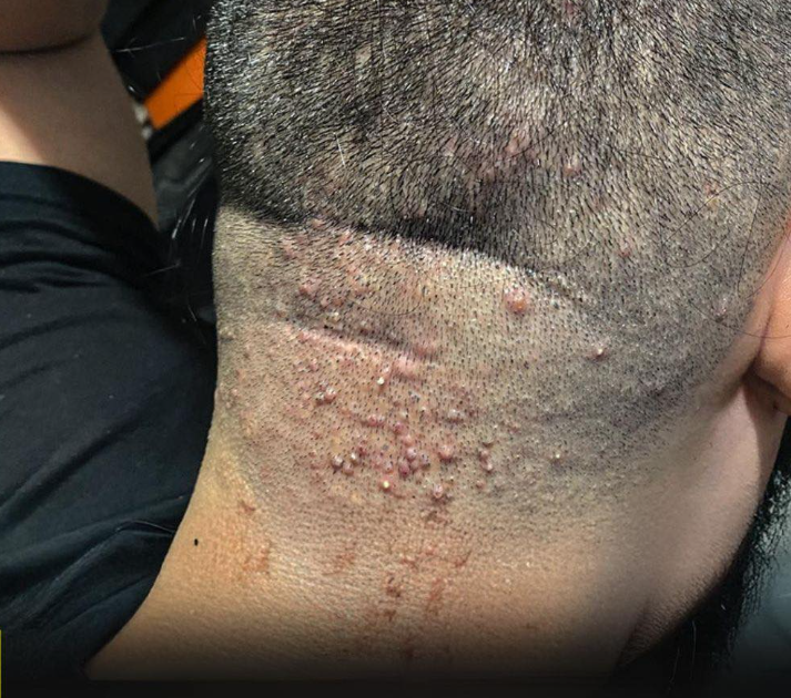 Hair salon alert: a common infection after a haircut and how to prevent it